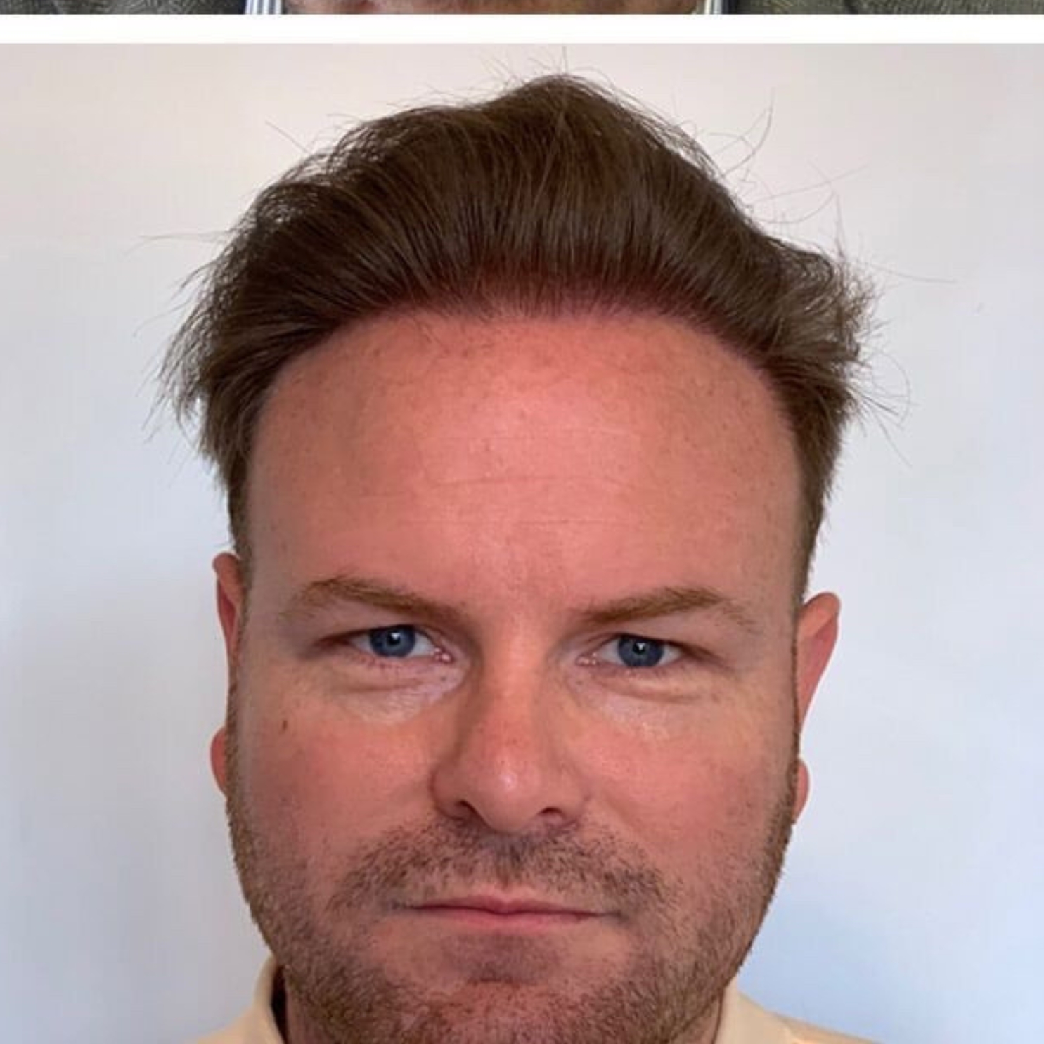 Hair Transplant